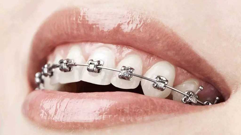 济宁口腔医院壹颗芽口腔_牙齿稀疏可以选择隐形牙齿矫正！