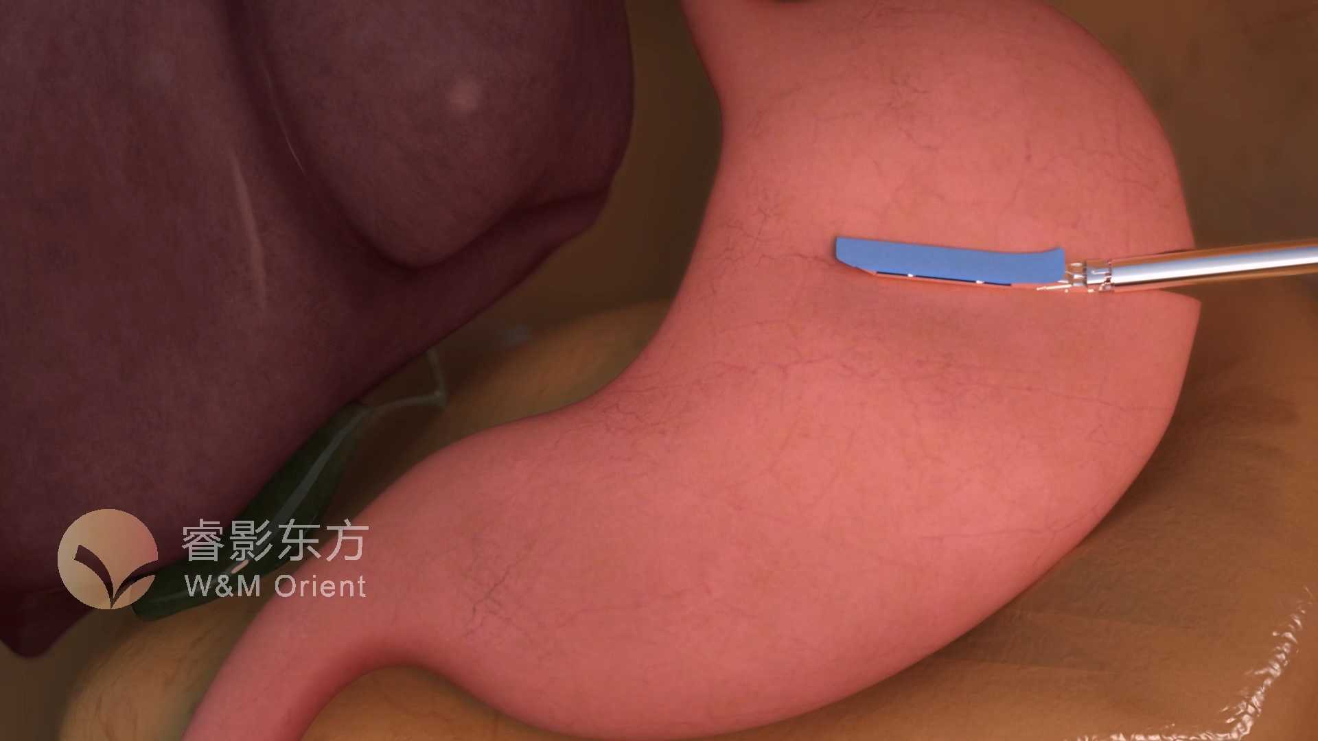 [3D医学动画]近端胃切除手术动画