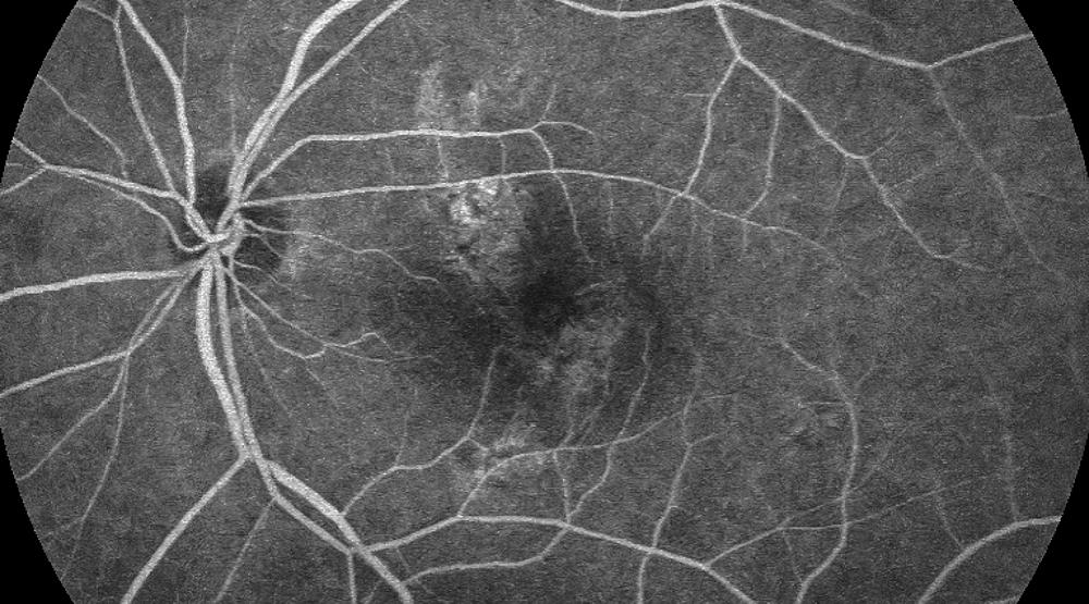 PCV荧光眼底血管造影动态视频