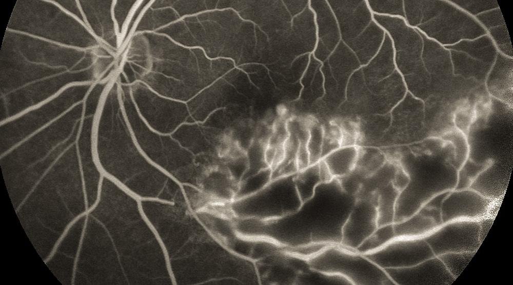 BRVO荧光眼底血管造影动态视频