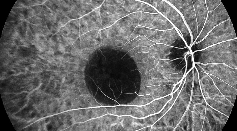 特发性PDE吲哚氰绿眼底血管造影动态视频