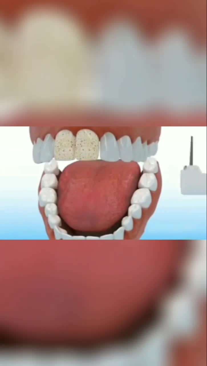 氟中毒会导致氟斑牙，看瓷贴面如何拯救氟斑牙！